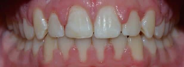 After teeth straightening