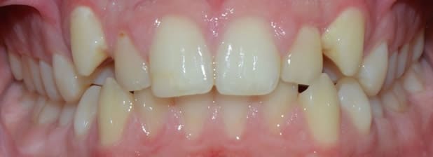 Before teeth straightening