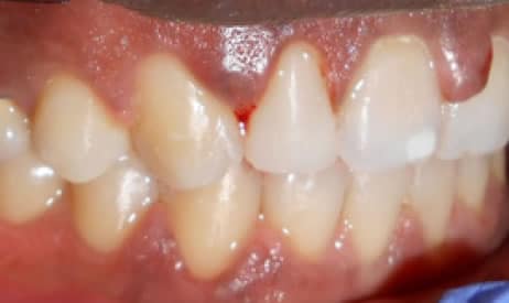 After teeth straightening