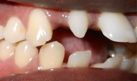 Before teeth straightening