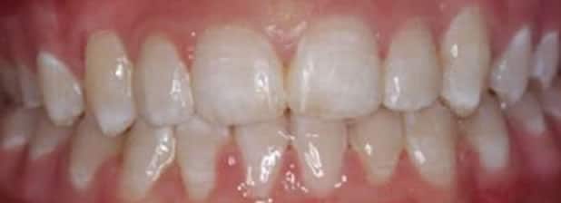 After teeth straightening