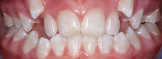 Before teeth straightening