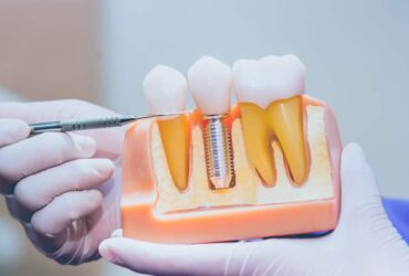 Dental Implants