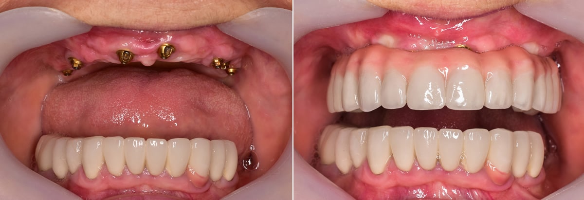 Dental implants before and after