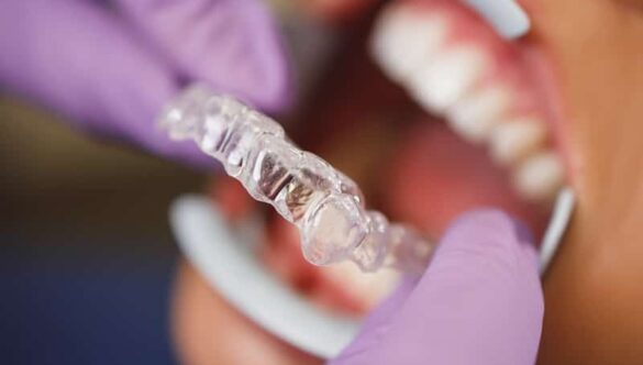 Discover Discreet Teeth Straightening Without Fixed Metal Braces