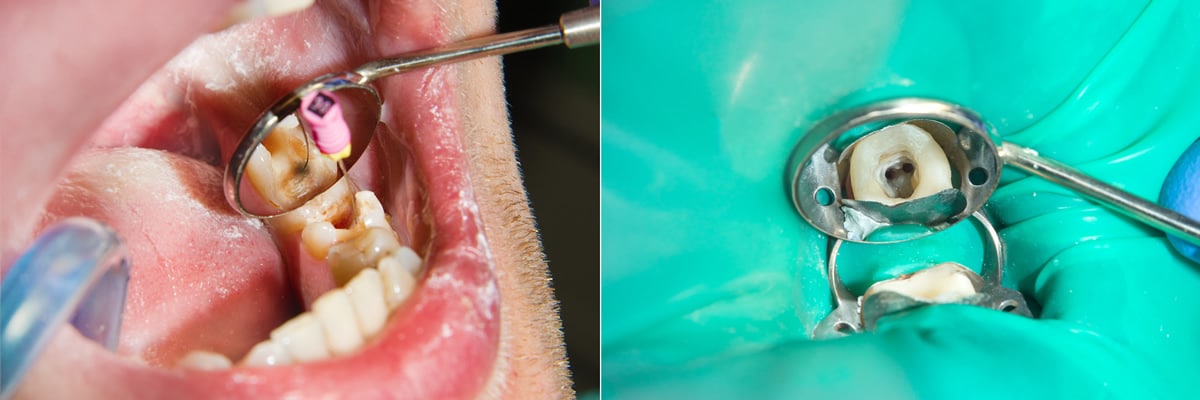 root canal treatment wakefield