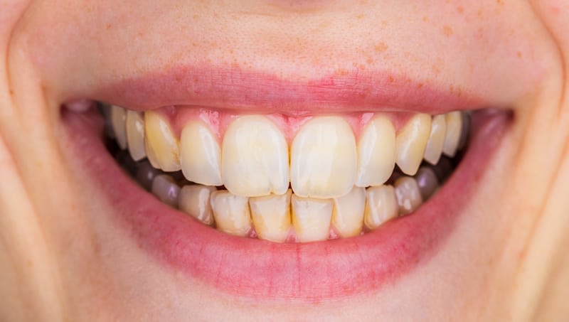 teeth whitening before