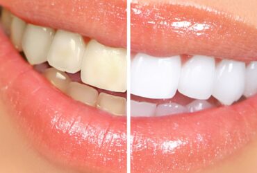 Fixed Braces