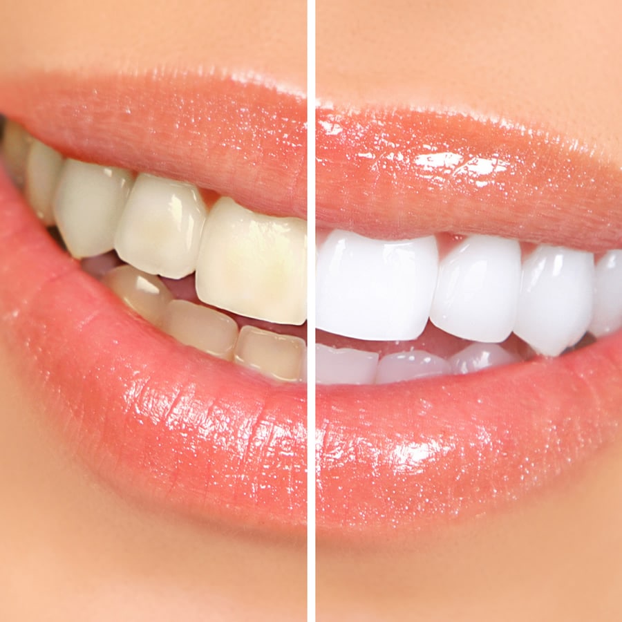 teeth whitening wakefield
