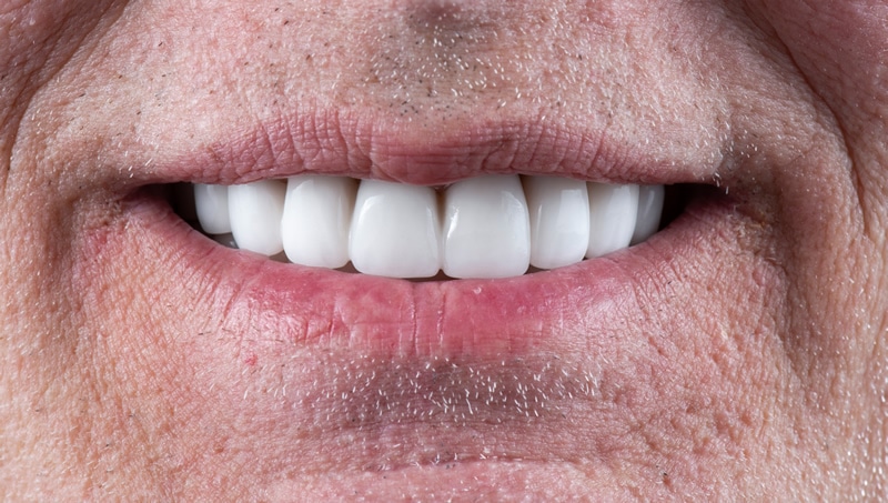 veneers after