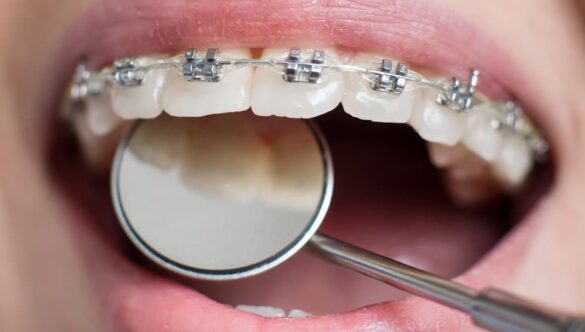 Teeth Straightening Options Explained: Your Guide to a Straighter Smile in Wakefield