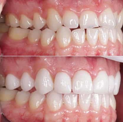 teeth whitening and crowns wakefield