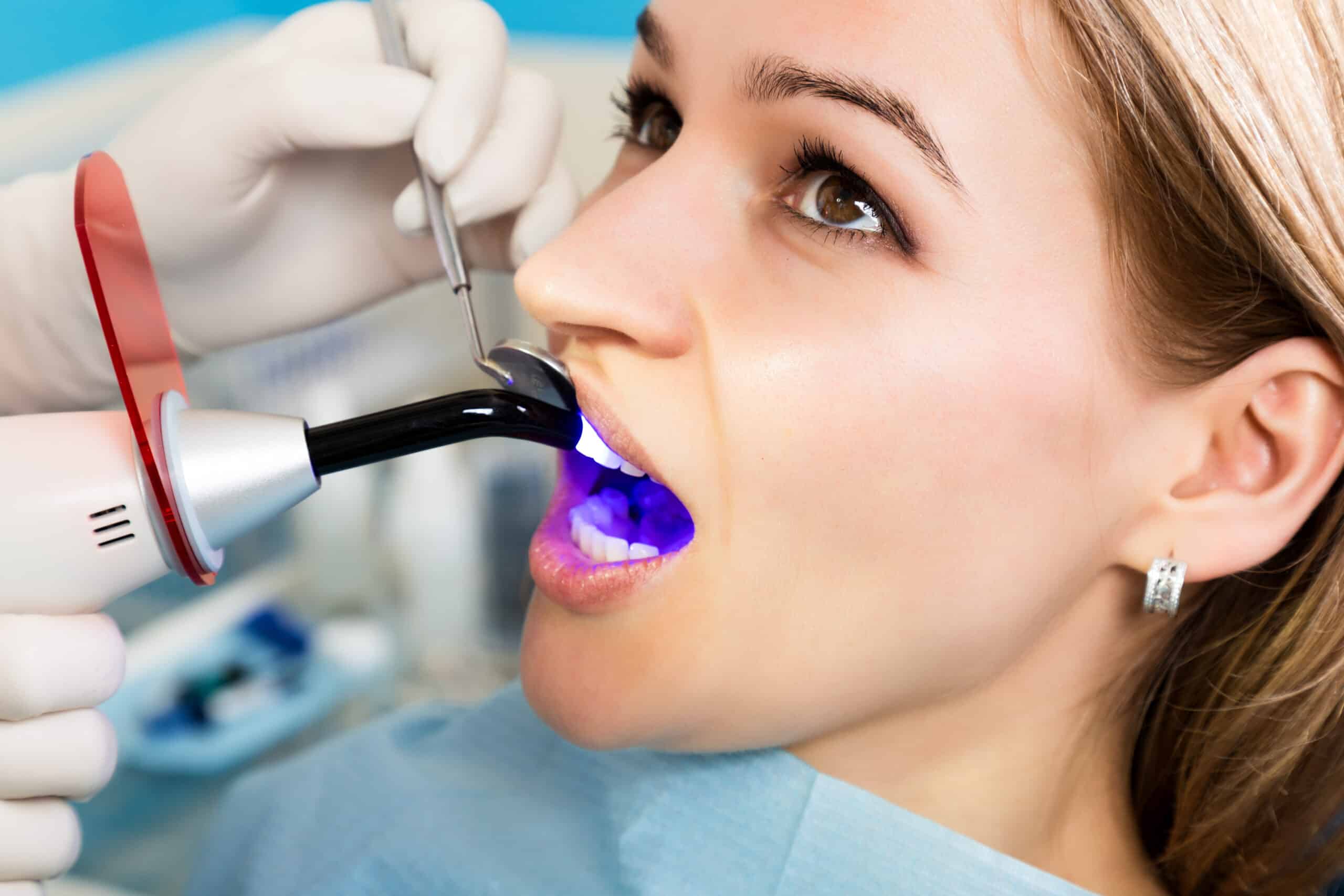 The reception was at the female dentist. Doctor examines the oral cavity on tooth decay. Caries protection. Tooth decay treatment. Dentist working with dental polymerization lamp in oral cavity