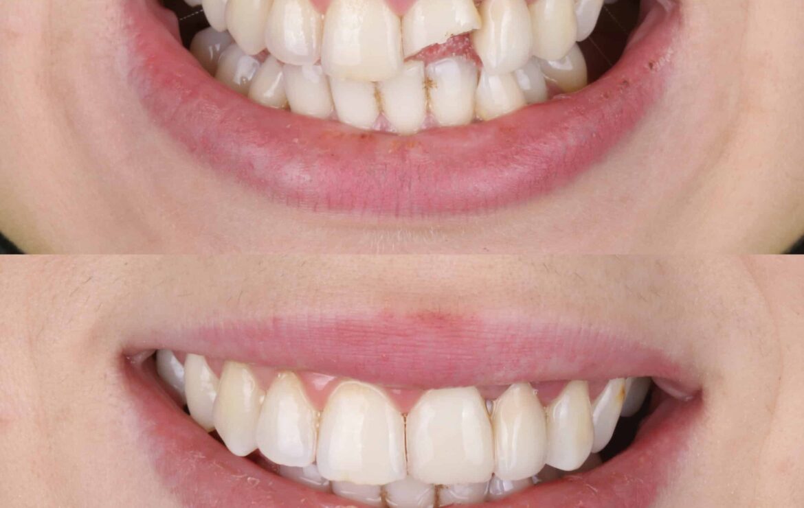 How To Fix A Chipped Tooth Quickly