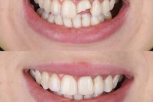 How To Fix A Chipped Tooth Quickly