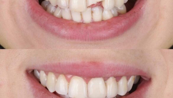 How To Fix A Chipped Tooth Quickly