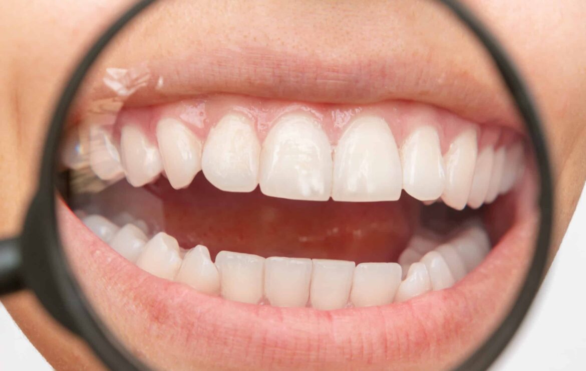 Can I Straighten Just My Top Teeth? What You Need To Know Before Starting Treatment
