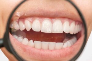 Can I Straighten Just My Top Teeth? What You Need To Know Before Starting Treatment