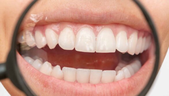 Can I Straighten Just My Top Teeth? What You Need To Know Before Starting Treatment
