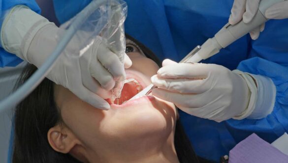 What Happens During a Root Canal? Step-by-Step Explained