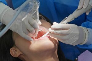 5 Signs You Might Need a Root Canal