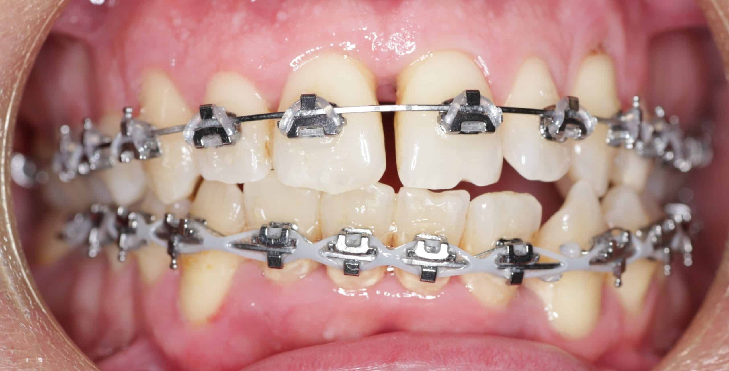 fastbraces 1
