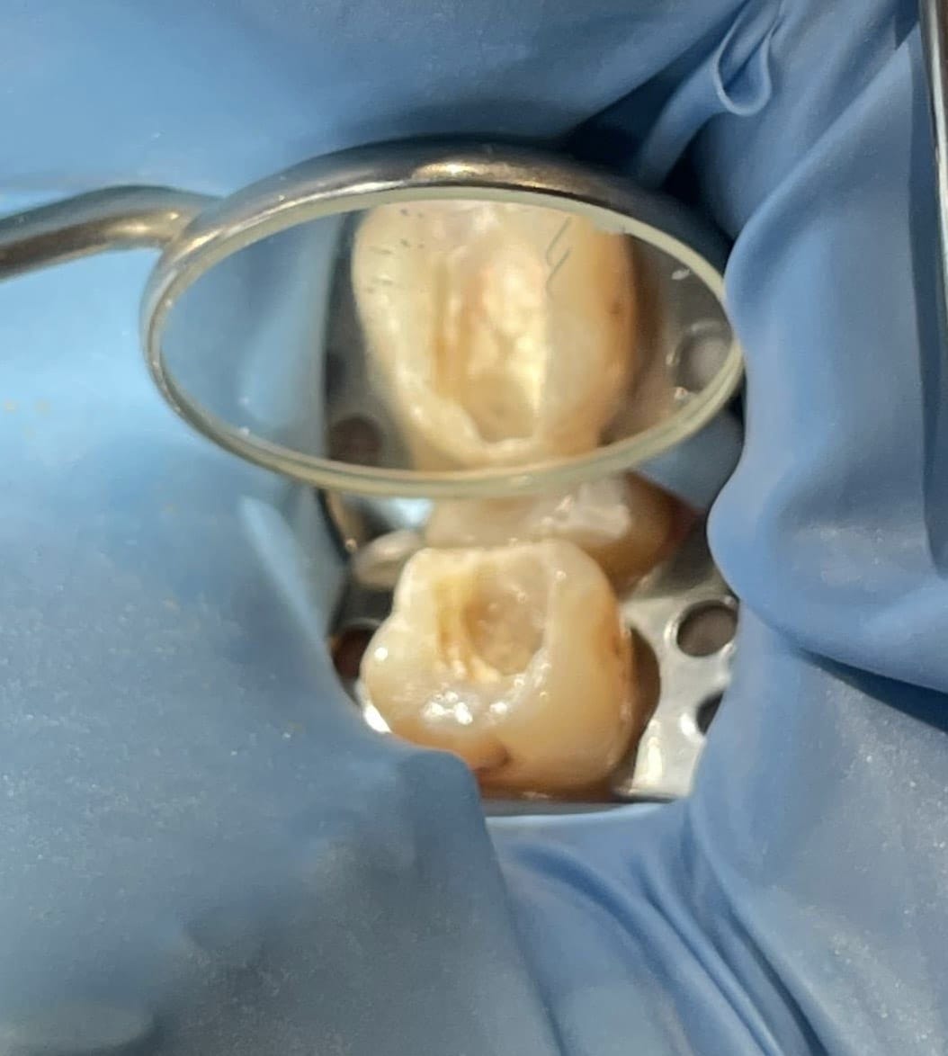 root canal 1
