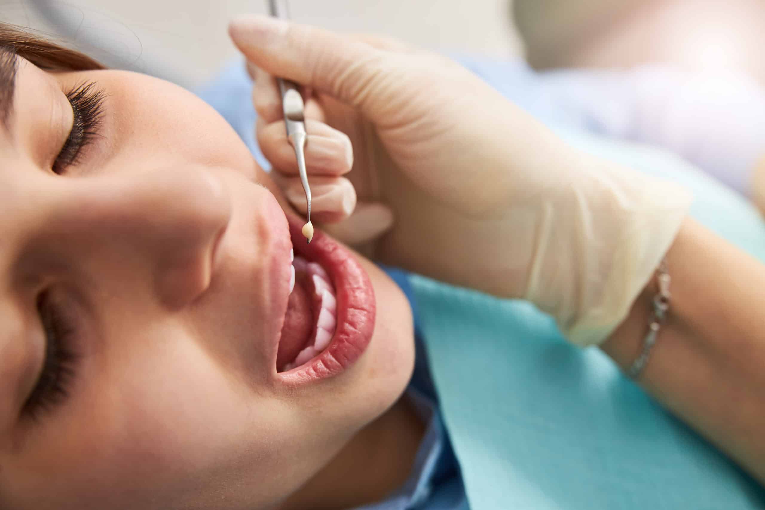 Patient with opened mouth ready for dental restoration with plugger